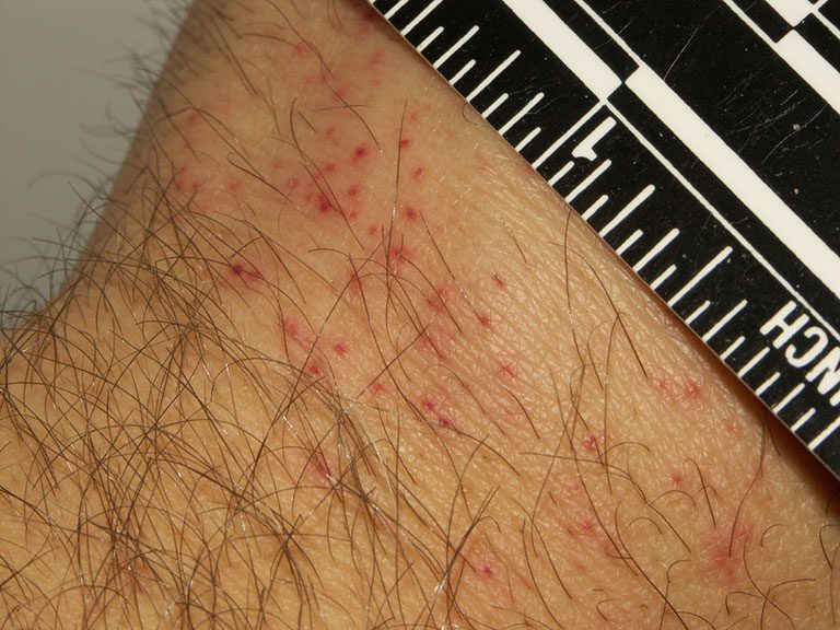 Bed bug bites on a man's arm with ruler